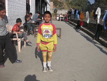 Danbahadur nu met protheses